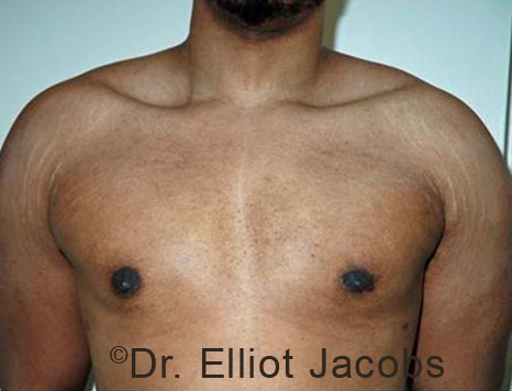 Male breast, after Gynecomastia treatment, front view, patient 98