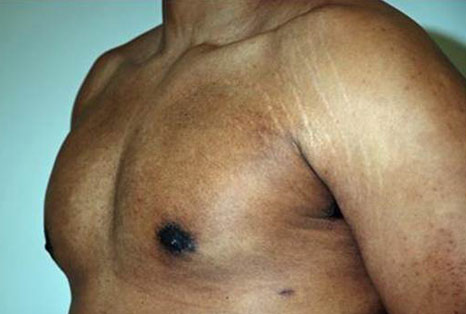 Male breast, after gynecomastia treatment, l-side oblique view, patient 265