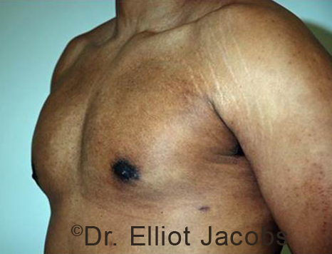 Male breast, after Gynecomastia treatment, l-side oblique view - patient 98