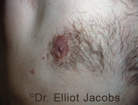 Men's breast, after Crater Deformity Repair treatment, front view - patient 4