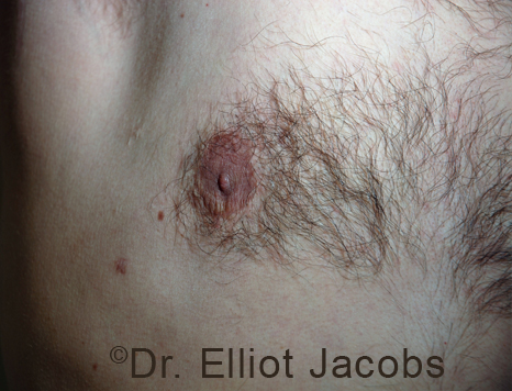 Men's breast, after Crater Deformity Repair treatment, front view, patient 4