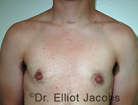 Gynecomastia. Male breast, after FTM Top Surgery treatment, front view, patient 1