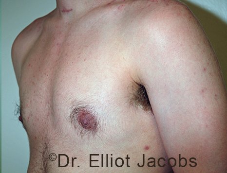 Gynecomastia. Male breast, after FTM Top Surgery treatment, l-side oblique view, patient 1