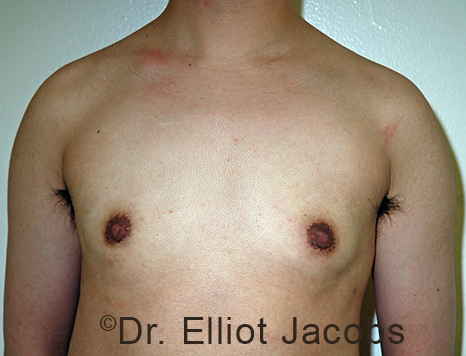 Male breast, after FTM Top Surgery treatment, front view, patient 2