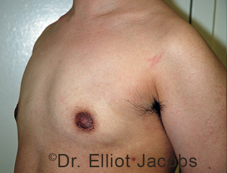 Gynecomastia. Male breast, after FTM Top Surgery treatment, l-side oblique view, patient 2