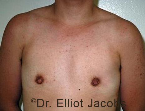 Gynecomastia. Male breast, after FTM Top Surgery treatment, front view, patient 3