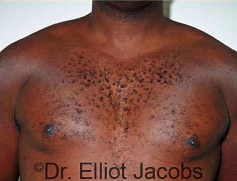 Male breast, after Gynecomastia treatment, front view, patient 27
