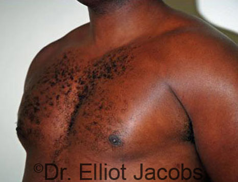 Male breast, after Gynecomastia treatment, l-side oblique view - patient 27