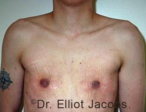 Gynecomastia. Male breast, after FTM Top Surgery treatment, front view, patient 4
