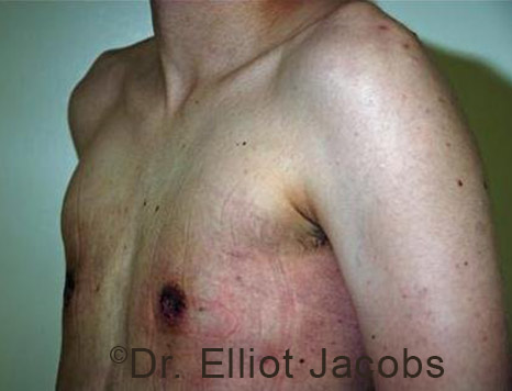 Gynecomastia. Male breast, after FTM Top Surgery treatment, l-side oblique view, patient 4