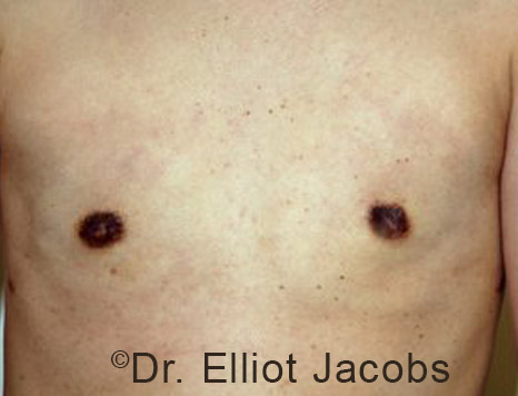 Gynecomastia. Male breast, after FTM Top Surgery treatment, front view, patient 5