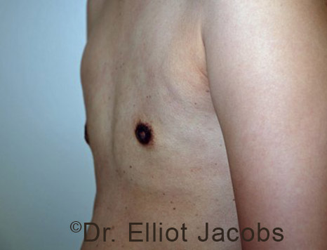 Gynecomastia. Male breast, after FTM Top Surgery treatment, l-side oblique view, patient 5