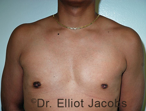 Male breast, after Gynecomastia treatment, front view, patient 99