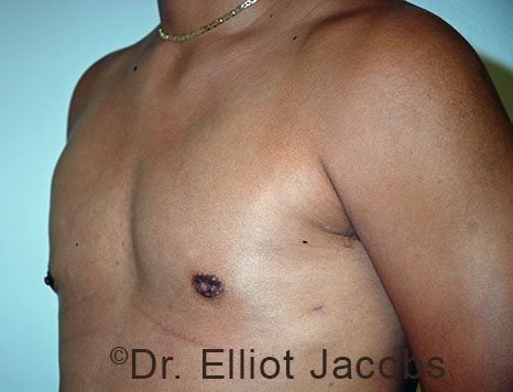Male breast, after Gynecomastia treatment, l-side oblique view - patient 99