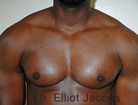 Male breast, after Gynecomastia treatment, front view, patient 100