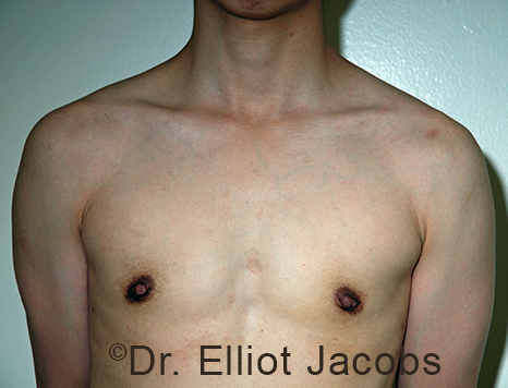 Gynecomastia. Male breast, after FTM Top Surgery treatment, front view, patient 6