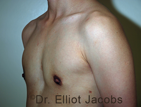 Gynecomastia. Male breast, after FTM Top Surgery treatment, l-side oblique view, patient 6