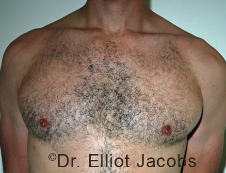 Male breast, after Gynecomastia treatment, front view, patient 101