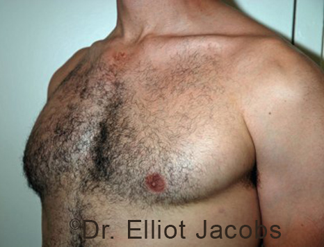 Male breast, after Gynecomastia treatment, l-side oblique view - patient 101