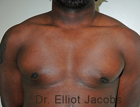 Male breast, after Gynecomastia treatment, front view, patient 102