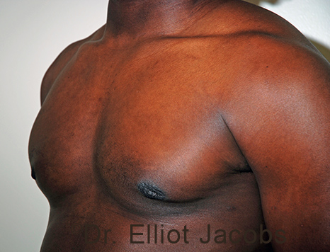 Male breast, after Gynecomastia treatment, l-side oblique view - patient 102