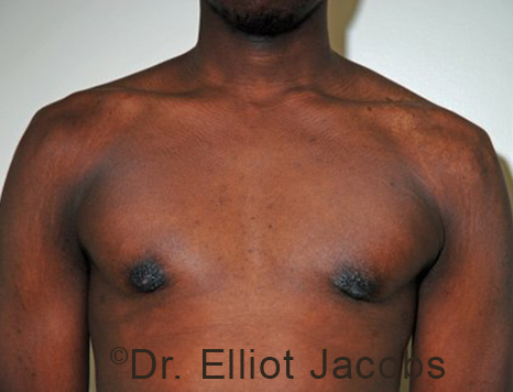 Male nipple, after Puffy Nipple treatment, front view - patient 34