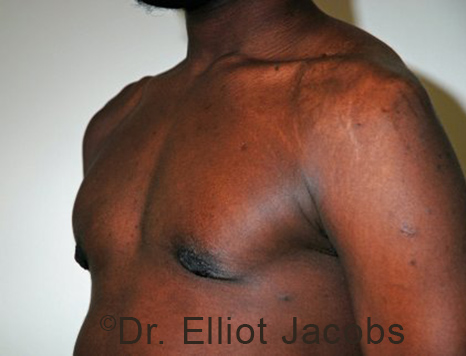 Male nipple, after Puffy Nipple treatment, l-side oblique view - patient 34