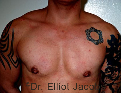 Gynecomastia. Male breast, after FTM Top Surgery treatment, front view, patient 7