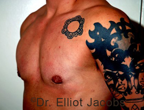 Gynecomastia. Male breast, after FTM Top Surgery treatment, l-side oblique view, patient 7