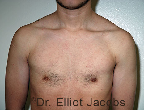 Gynecomastia. Male breast, after FTM Top Surgery treatment, front view, patient 8