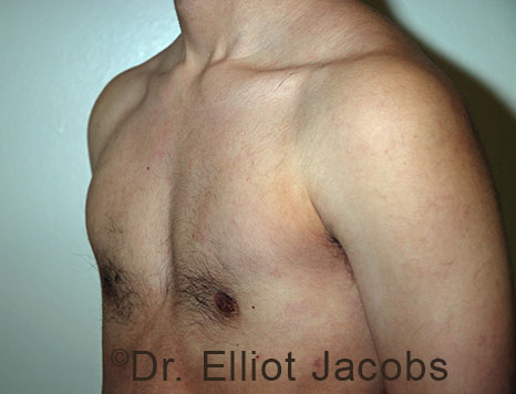 Gynecomastia. Male breast, after FTM Top Surgery treatment, l-side oblique view, patient 8