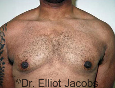 Male breast, after Gynecomastia treatment, front view, patient 28