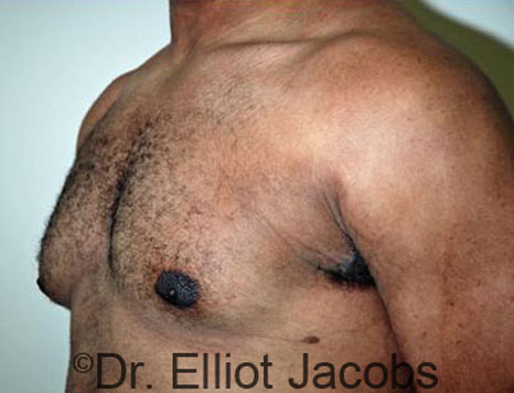 Male breast, after Gynecomastia treatment, l-side oblique view - patient 28