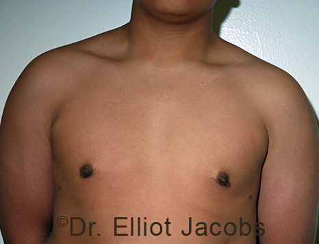 Men's breast, after Gynecomastia Adolescent treatment, front view - patient 36