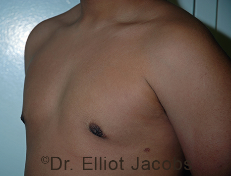 Men's breast, after Gynecomastia Adolescent treatment, oblique view - patient 36