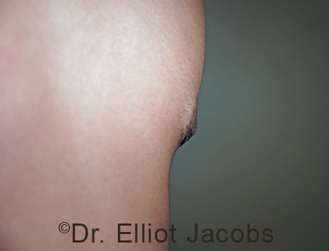 Male nipple, after Puffy Nipple treatment, r-side oblique view - patient 35