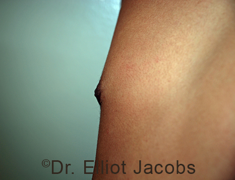 Male nipple, after Puffy Nipple treatment, l-side oblique view - patient 35
