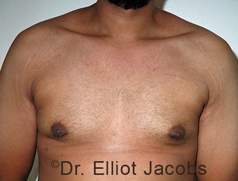 Male breast, after Gynecomastia treatment, front view, patient 104