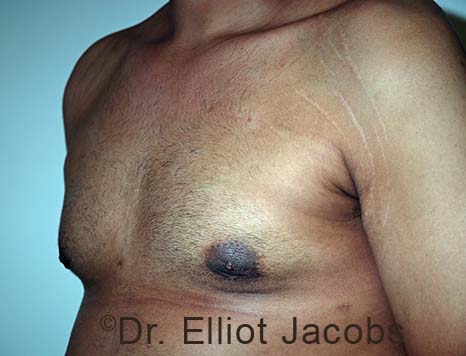 Male breast, after Gynecomastia treatment, l-side oblique view - patient 104