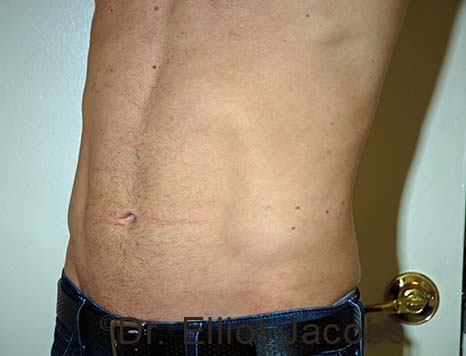 Male body, after Torsoplasty treatment, l-side oblique view, patient 29
