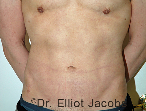 Male body, after Torsoplasty treatment, front view, patient 30