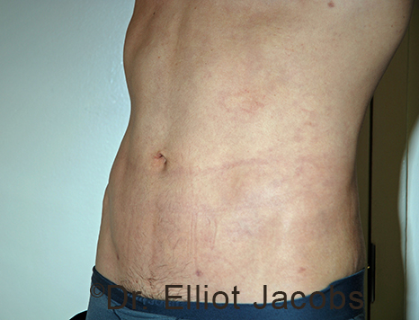 Male body, after Torsoplasty treatment, l-side oblique view, patient 30