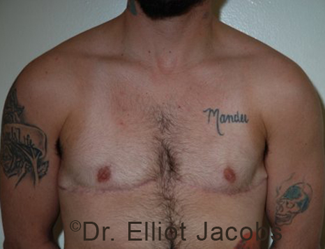 Gynecomastia. Male breast, after FTM Top Surgery treatment, front view, patient 9