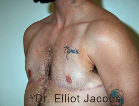 Gynecomastia. Male breast, after FTM Top Surgery treatment, l-side oblique view, patient 9