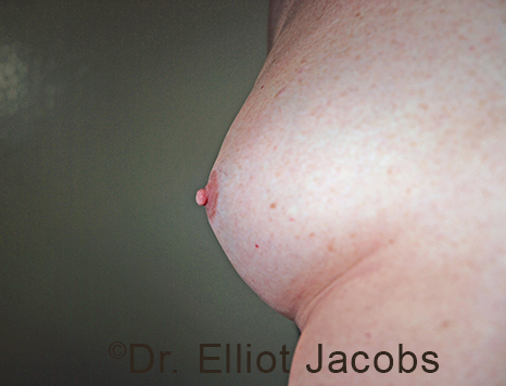 Male nipple, after Puffy Nipple treatment, oblique view - patient 52