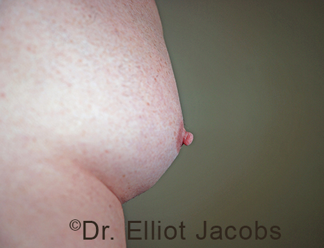 Male nipple, after Puffy Nipple treatment, side view - patient 52