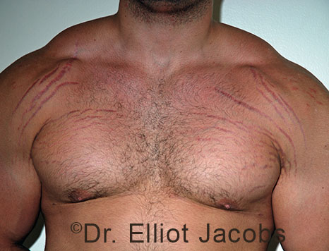 Male breast, before Gynecomastia treatment, front view, patient 105