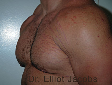Male nipple, after Puffy Nipple treatment, l-side oblique view - patient 36