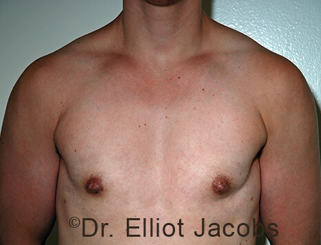 Gynecomastia. Male breast, after FTM Top Surgery treatment, front view, patient 10