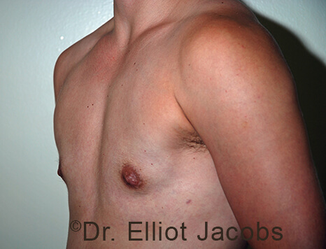 Gynecomastia. Male breast, after FTM Top Surgery treatment, l-side oblique view, patient 10